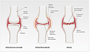 artrosi